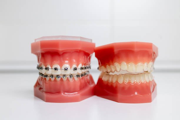 5 Advantages of Choosing Aligners over Braces