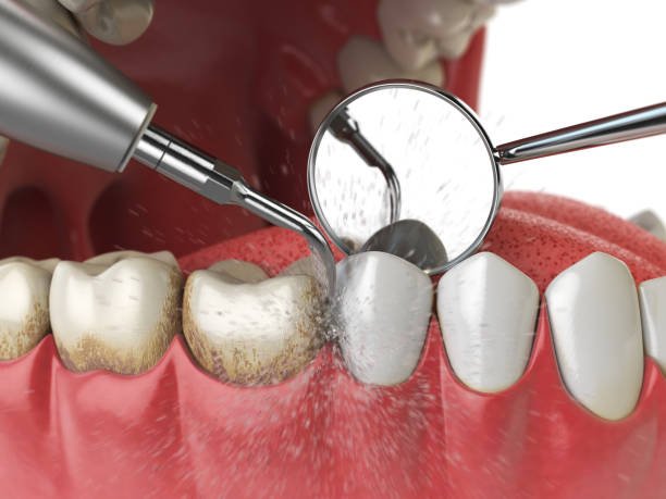 Why is Teeth Cleaning Important?